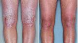 Photos of Psoriasis Treatment In Usa