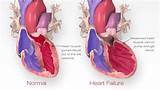 Can You Have Congestive Heart Failure With A Pacemaker Images
