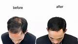 Blood Platelet Hair Loss Treatment Photos