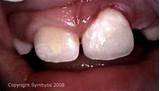 Pictures of Front Tooth Chipped Bonding