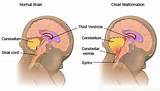 Pictures of Chiari Malformation Headache Treatment