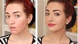 Makeup For Acne Scarred Skin Photos