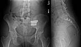 Si Joint Fusion Surgery Recovery Pictures