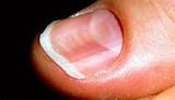 Images of Pink Toenails Medical Condition