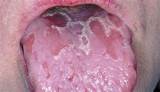 Blister On Side Of Tongue Treatment Photos