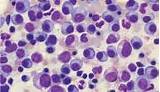 Advances In Lymphoma Treatment Pictures