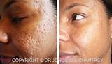 Photos of Acne Scar Laser Treatment Uk