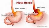 Hiatal Hernia Pain Relief Treatment