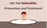 Photos of Spa Pool Folliculitis