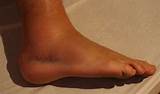 Pictures of Sprained Ankle Recovery Tips
