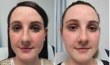 Pictures of How To Get Rid Of Freckles Laser Treatment