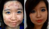 Makeup That Covers Pimples Photos