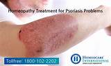 Photos of Is There A Treatment For Psoriasis