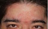 Seborrheic Dermatitis Eyelids Treatment Pictures