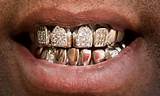 Permanent Gold Teeth In Texas