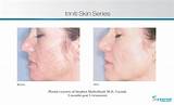 Pictures of Triniti Laser Treatment