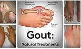 Images of Any Home Remedies For Gout