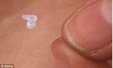 Tubes In Ears Surgery For Infants Images