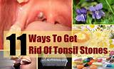 Tonsilloliths Home Remedies Images