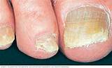 Foot Doctor For Nail Fungus Images