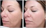How Much Is Facial Laser Treatment Images