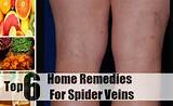 Latest Treatment For Spider Veins