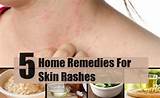 Skin Rash Treatment Home Remedies Images