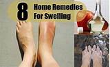 Pictures of Edema Feet Home Remedies