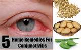 Viral Conjunctivitis Home Remedies