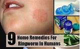 Ringworms Home Remedies Pictures