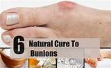 Pictures of Treatment For Bunions On Big Toe
