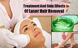 Hair Removal Laser Side Effects Cancer Pictures