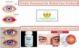 Images of Uveitis Symptoms And Treatment