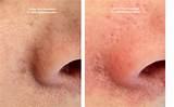 Photos of Spider Veins On Nose Laser Treatment