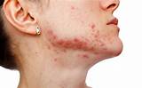 Images of Pcos And Acne Treatment