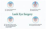 Lasik Eye Surgery Bend Or
