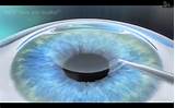 Pictures of Refractive Lasik Surgery