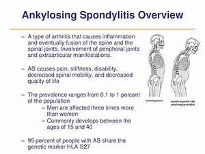 Ppt Treatment Of Ankylosing Spondylitis Powerpoint Presentation Free