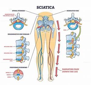 Sciatica Or Nerve Weakness As Leg Lumbar Radiculopathy Outline