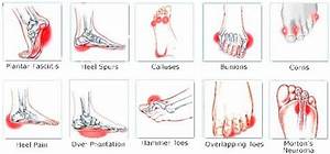 Different Type Of Foot Archs Pinterest Foot And Feet Care
