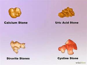 Jamillah Khan 39 S Hsc4233 Blog Types Of Kidney Stones