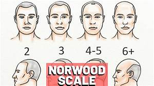 Norwood Scale Explained With 7 Real Examples Youtube