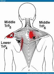 Myofascial Trigger Points In Patients With Shoulder 