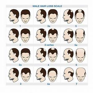 Causes Of Hair Loss Edmonton Nakatsui Hair Transplant