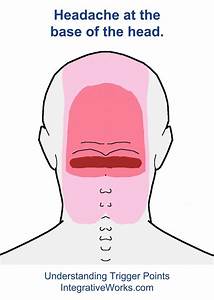 Headache At The Base Of The Head Cervicogenic Headache Trigger Points