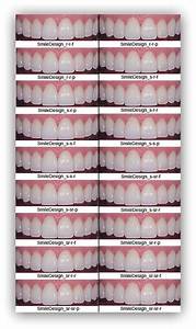 Styles Shapes Colors Of Porcelain Veneers Veneers Teeth Dental