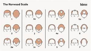 The Norwood Scale Hair Loss Stages Treatments Hims