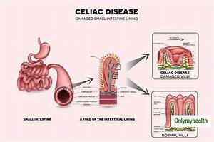 Celiac Disease Diet Tips Complete Diet Chart For Celiac Disease