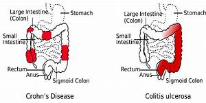 Differences Between Crohn 39 S Disease And Ulcerative Colitis Lorecentral
