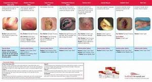 Dressing Selection Guide Hollister Wound Care Wound Care Wound